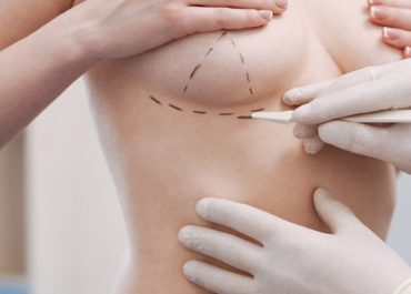 Nâng ngực bằng mỡ tự thân phù hợp với ai