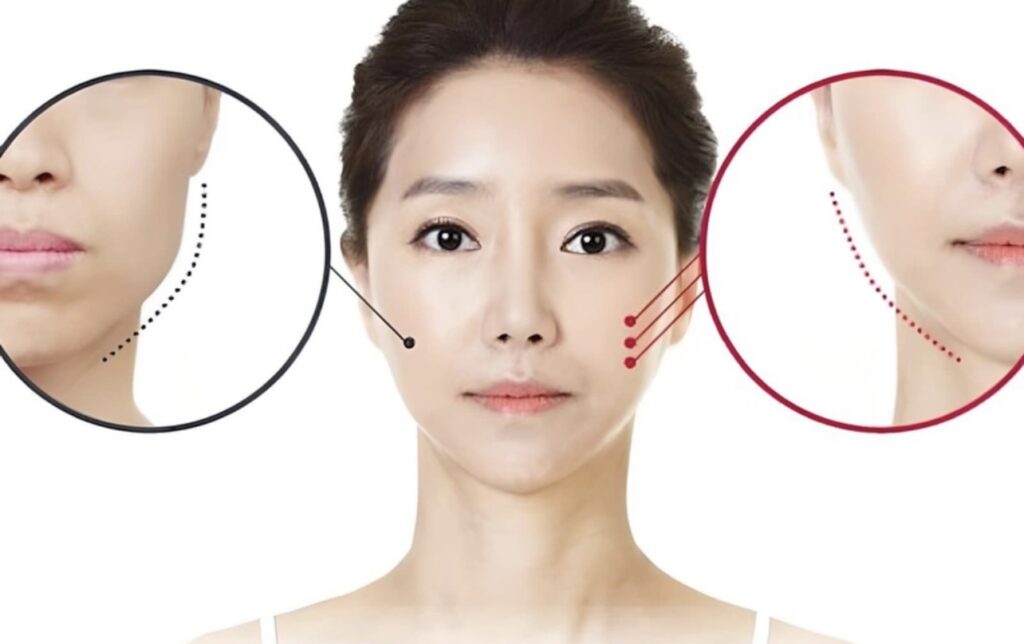 Công dụng của tiêm botox trong trẻ hóa da