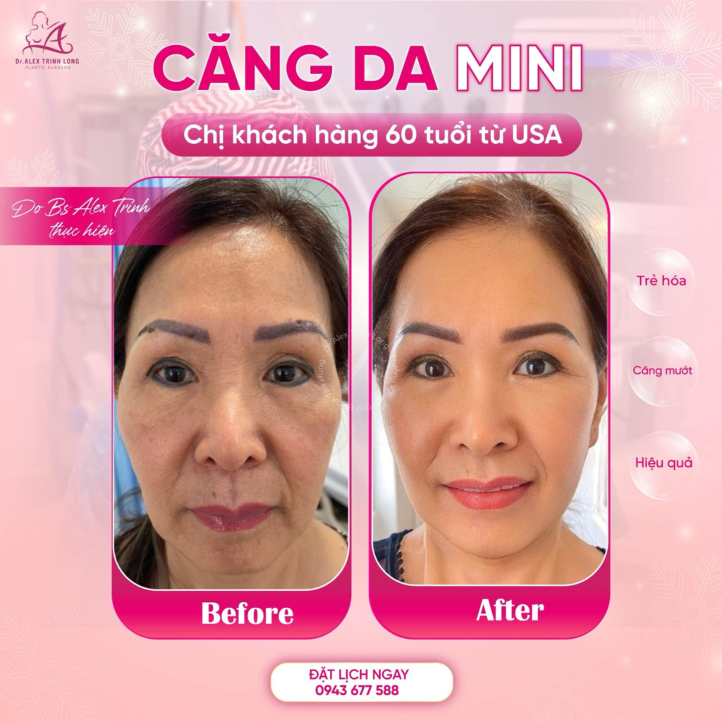 Khách hàng phẫu thuật căng da mặt tại Dr Alex Trịnh Long