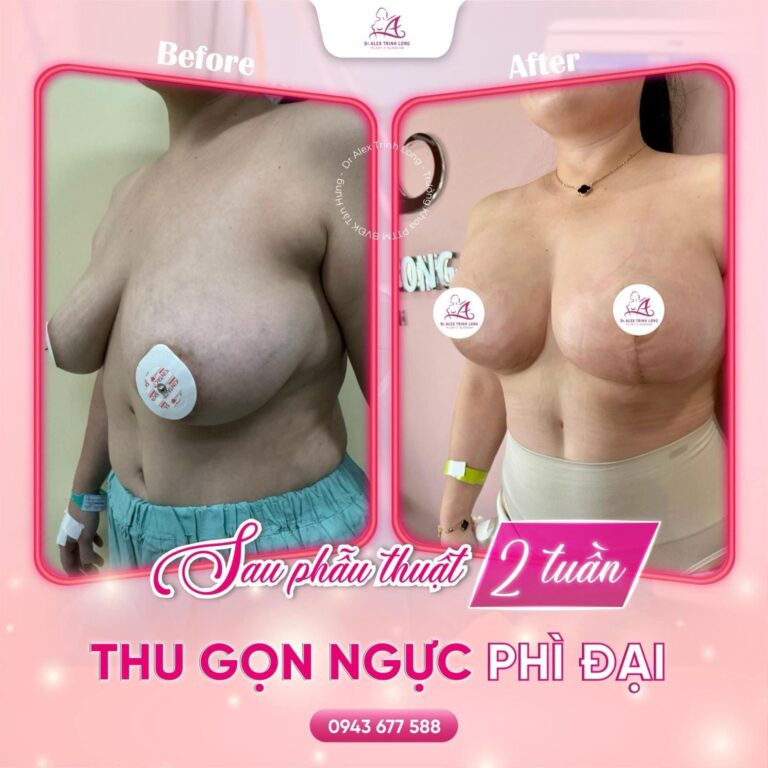 Thu gọn ngực phì đại và những điều cần biết