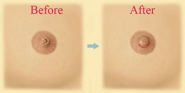 Thu gọn quầng ngực tự nhiên